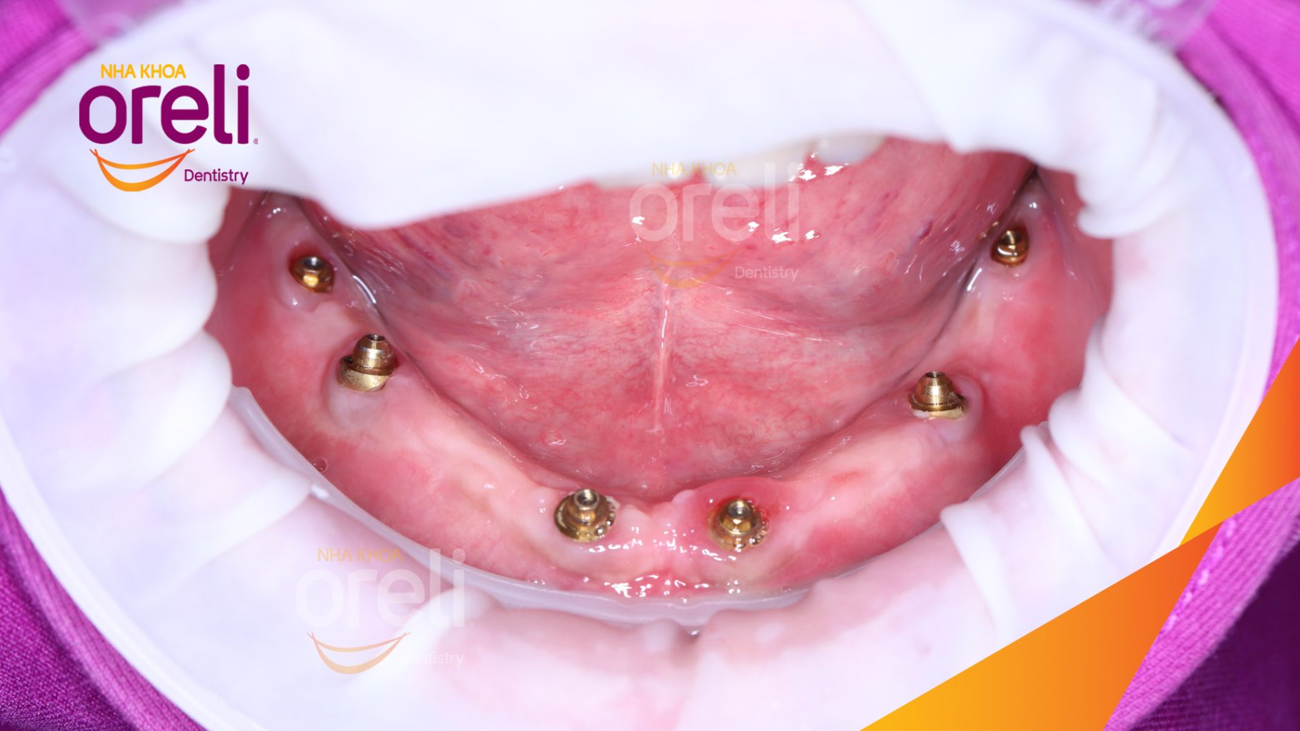 Quá trình Trồng răng implant toàn hàm dưới và vùng răng sau hàm trên trong 3 tháng tại Nha khoa Oreli Buôn Ma Thuột