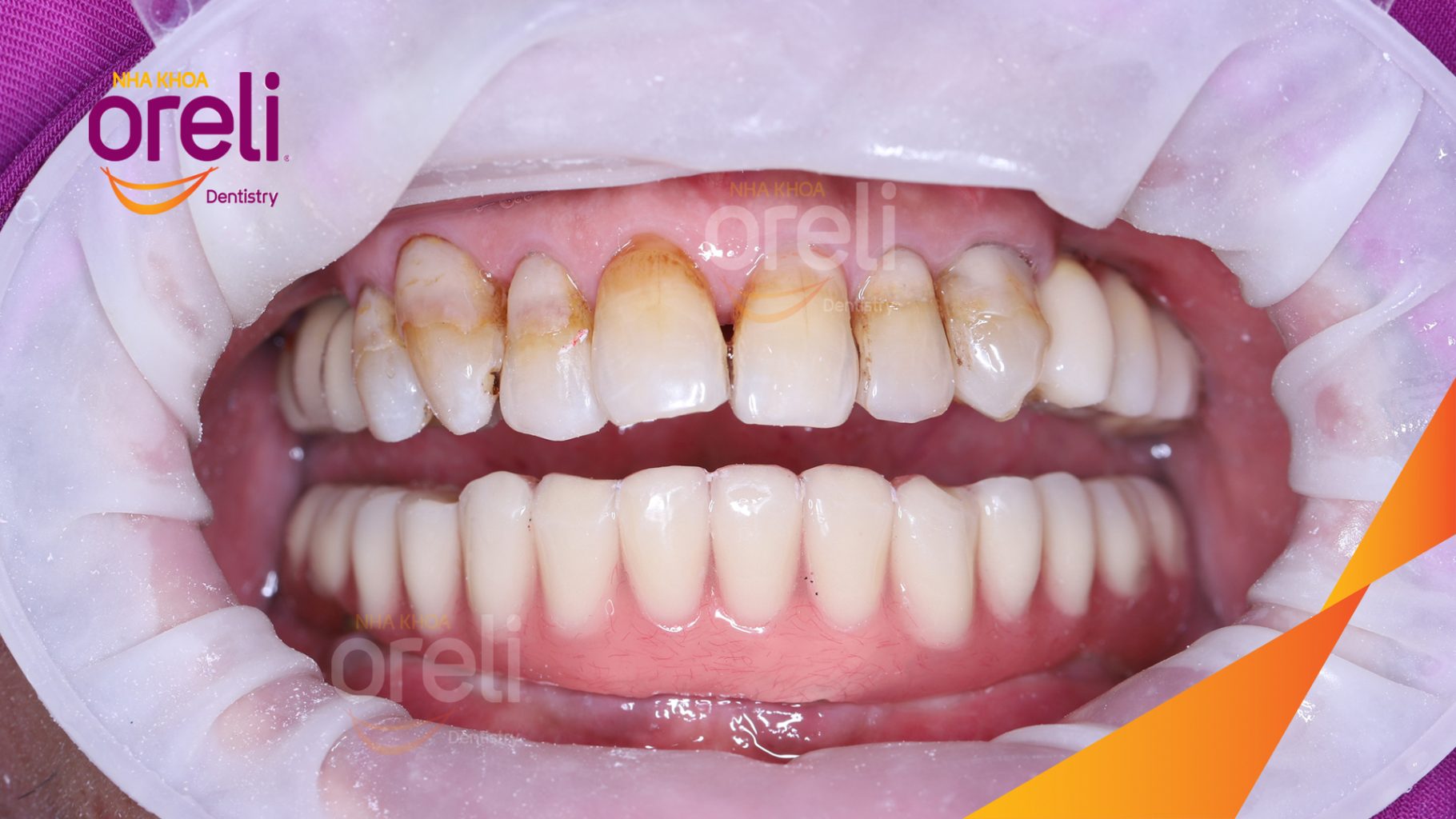 Thực hiện Trồng răng implant toàn hàm dưới và vùng răng sau hàm trên kéo dài 3 tháng tại Nha khoa Oreli Buôn Ma Thuột