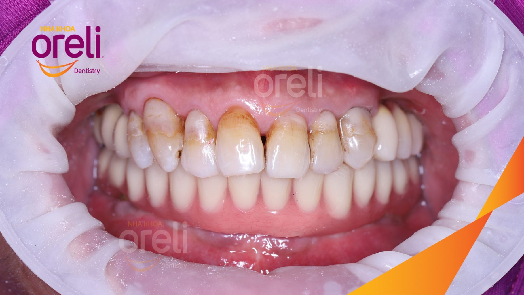 Trước điều trị: Mất răng nhai vùng hàm trên và dưới  tại Nha khoa Oreli Buôn Ma Thuột