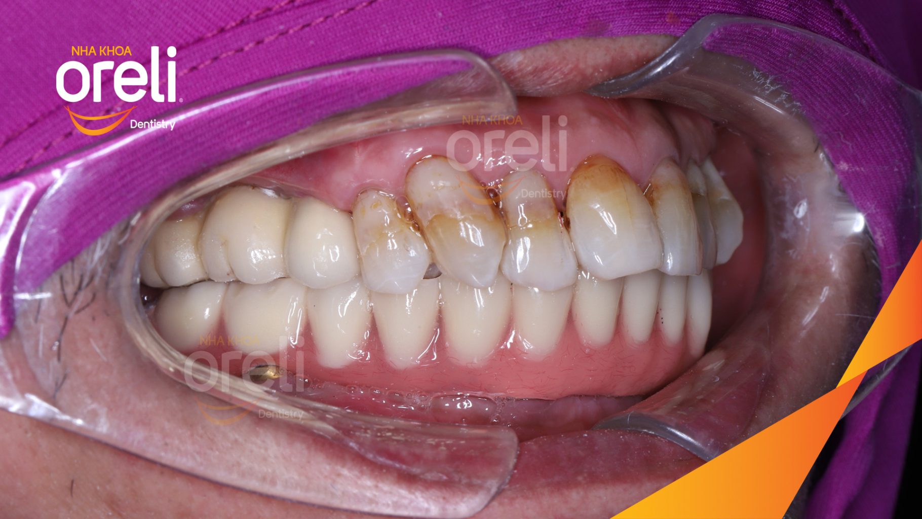 Kết quả sau 3 tháng: Ăn nhai tốt và thoải mái trong miệng tại Nha khoa Oreli Buôn Ma Thuột