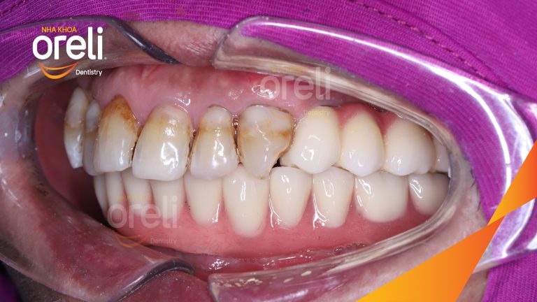 Trồng răng implant hàm dưới phục hồi nhai | Ca thực tế tại Oreli