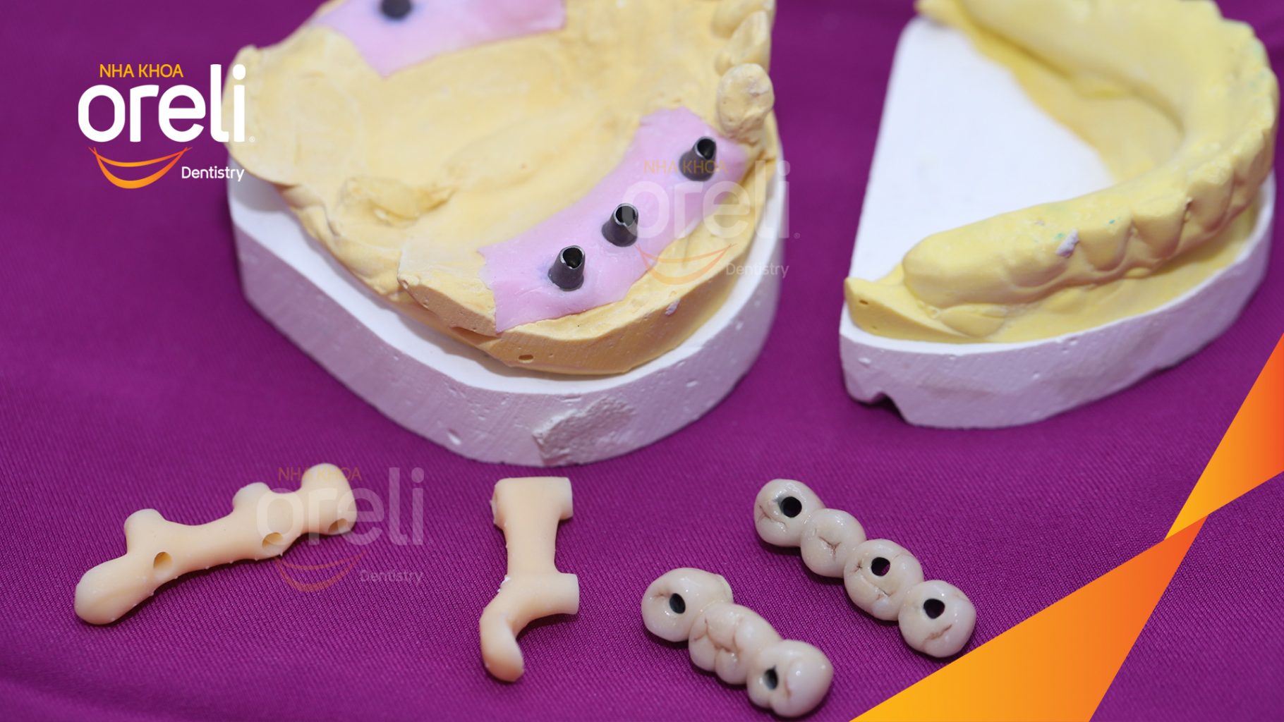 Quá trình Trồng răng implant toàn hàm dưới và vùng răng sau hàm trên trong 3 tháng tại Nha khoa Oreli Buôn Ma Thuột