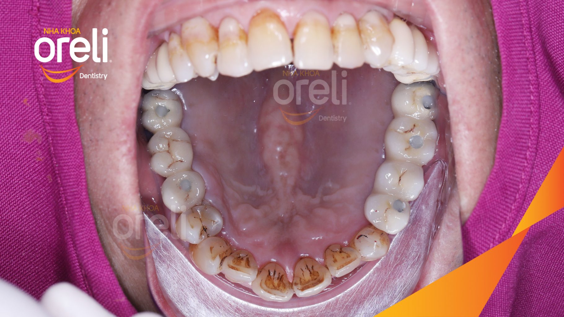 Mất răng nhai vùng hàm trên và dưới  trước khi điều trị tại Nha khoa Oreli Buôn Ma Thuột