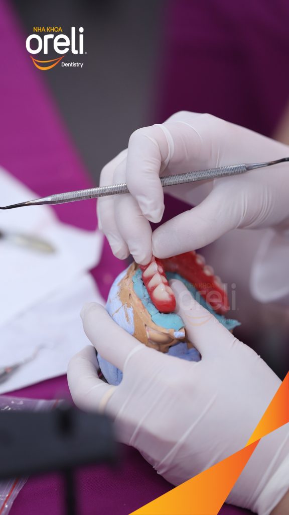 Trước điều trị: Cầu răng sứ lâu ngày, tiêu xương nhiều ở cả hàm trên và dưới tại Nha khoa Oreli