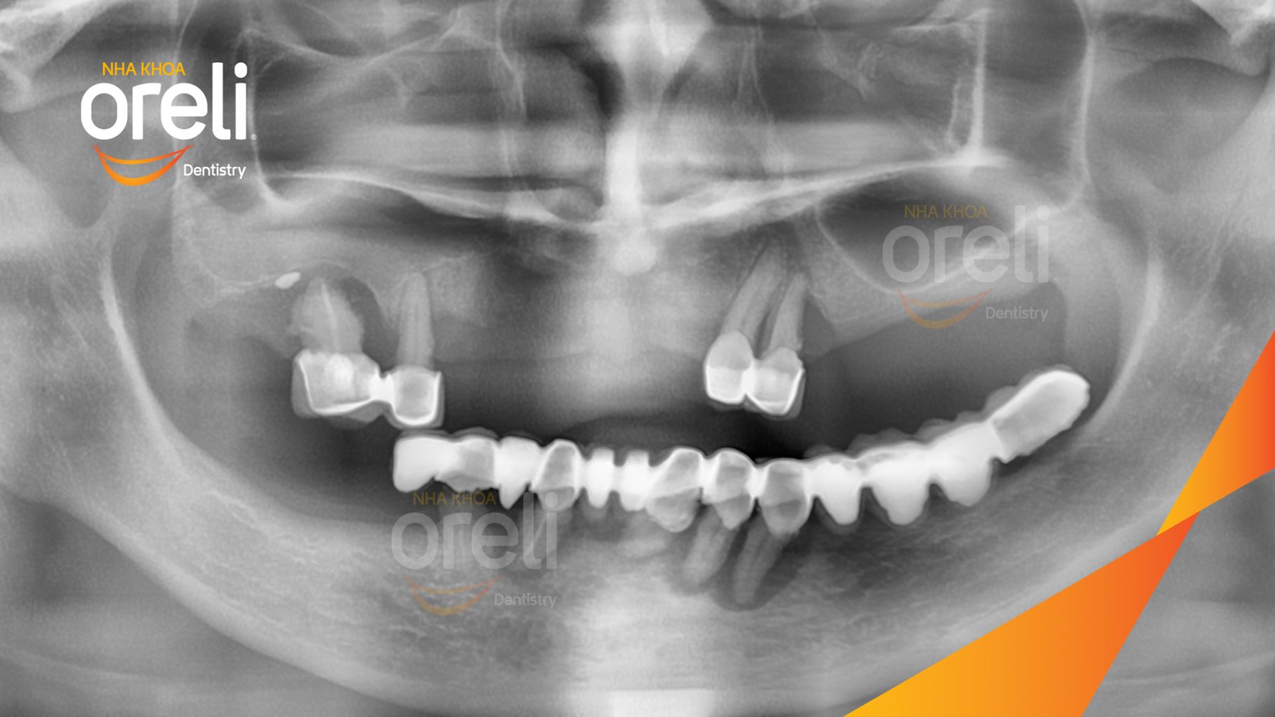 Trước điều trị: Cầu răng sứ lâu ngày, tiêu xương nhiều ở cả hàm trên và dưới tại Nha khoa Oreli