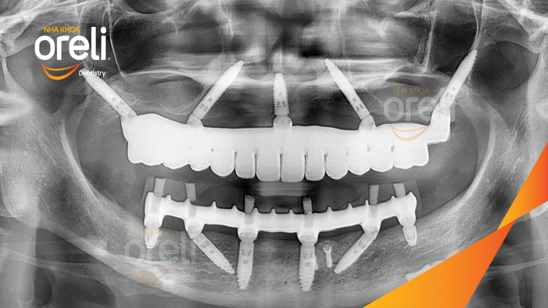 Cầu răng sứ lâu ngày, tiêu xương nhiều ở cả hàm trên và dưới trước khi điều trị tại Nha khoa Oreli