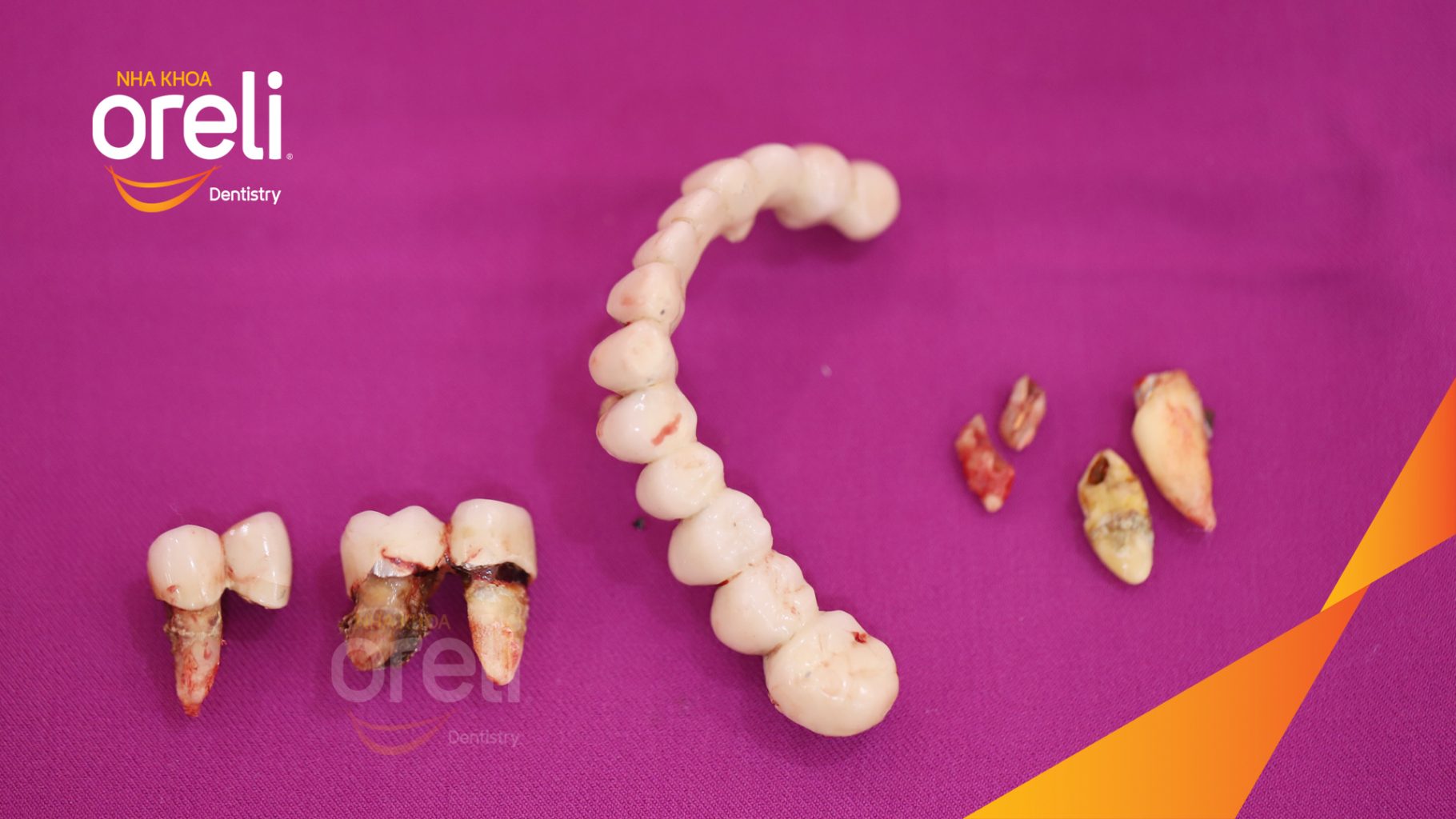 Thực hiện Cắt bỏ cầu sứ nhổ răng lung lay, cấy ghép răng implant hàm trên và dưới kéo dài 2 tuần tại Nha khoa Oreli