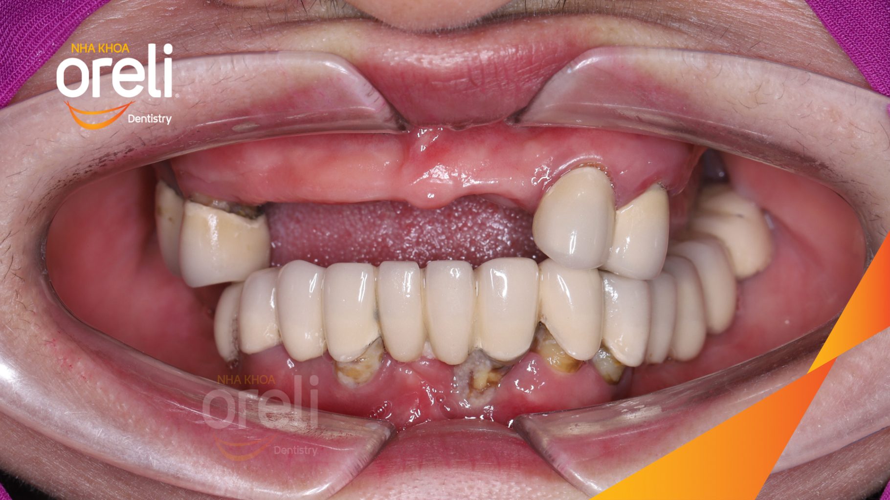 Quá trình Cắt bỏ cầu sứ nhổ răng lung lay, cấy ghép răng implant hàm trên và dưới trong 2 tuần tại Nha khoa Oreli