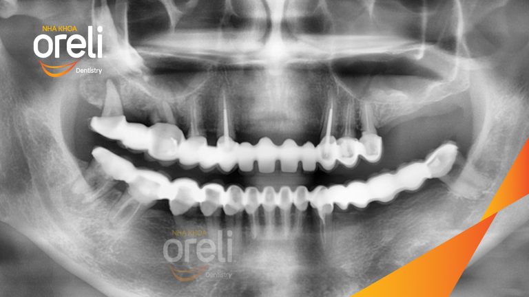 Ca trồng răng implant hàm trên và ba răng hàm dưới hình ảnh trước sau