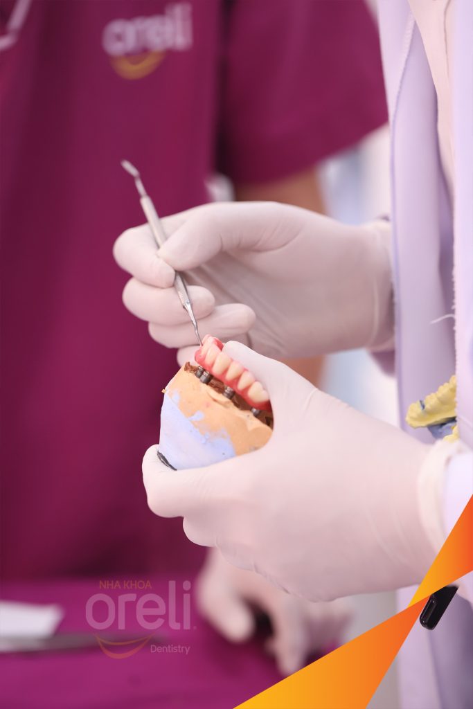 Thực hiện Cắt bỏ cầu răng nhổ các chân răng trồng implant all on six kéo dài 1 tuần tại Nha khoa Oreli