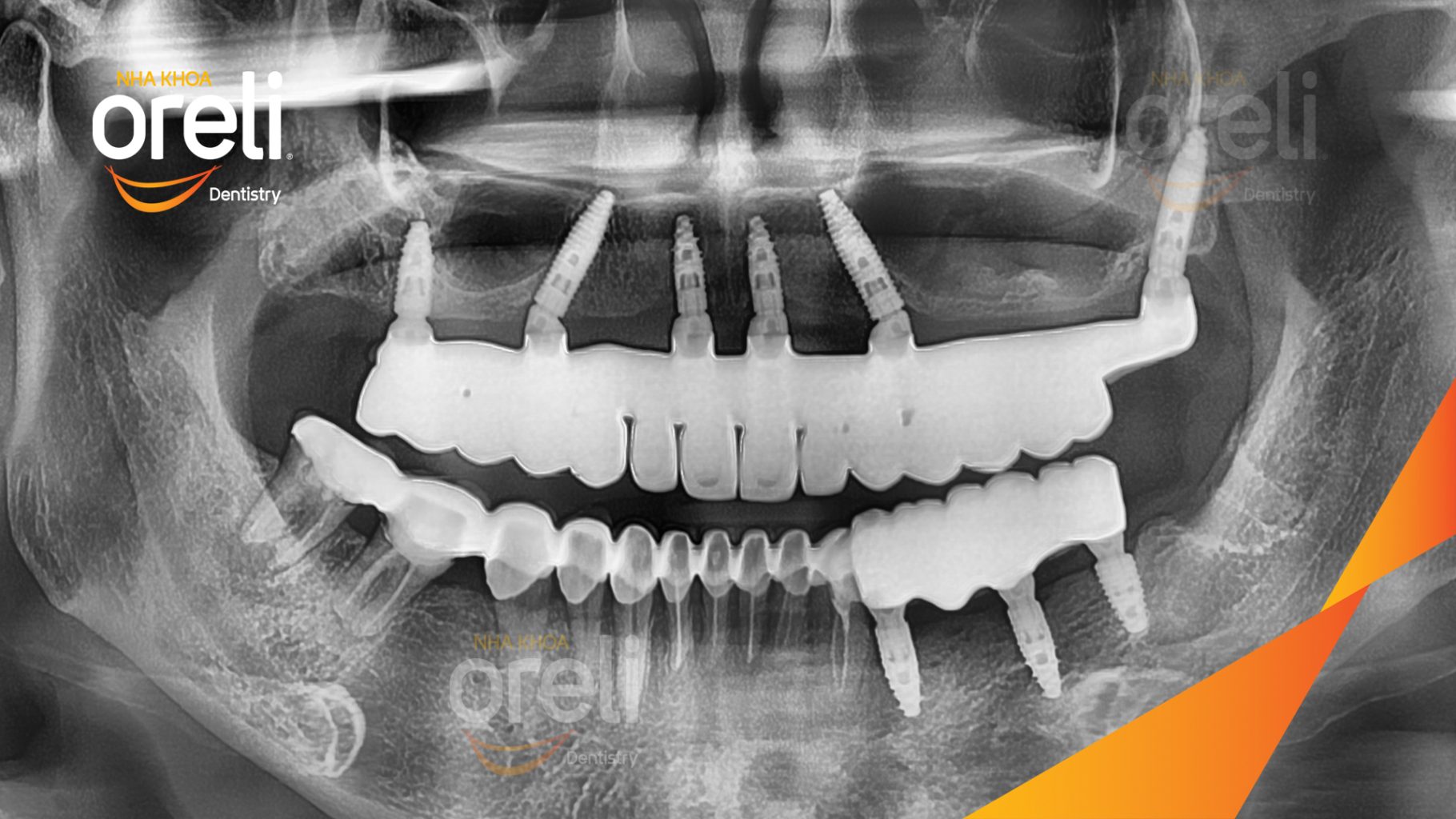 Cầu răng sứ hàm trên lung lay, các chân răng cũ tiêu xương trước khi điều trị tại Nha khoa Oreli