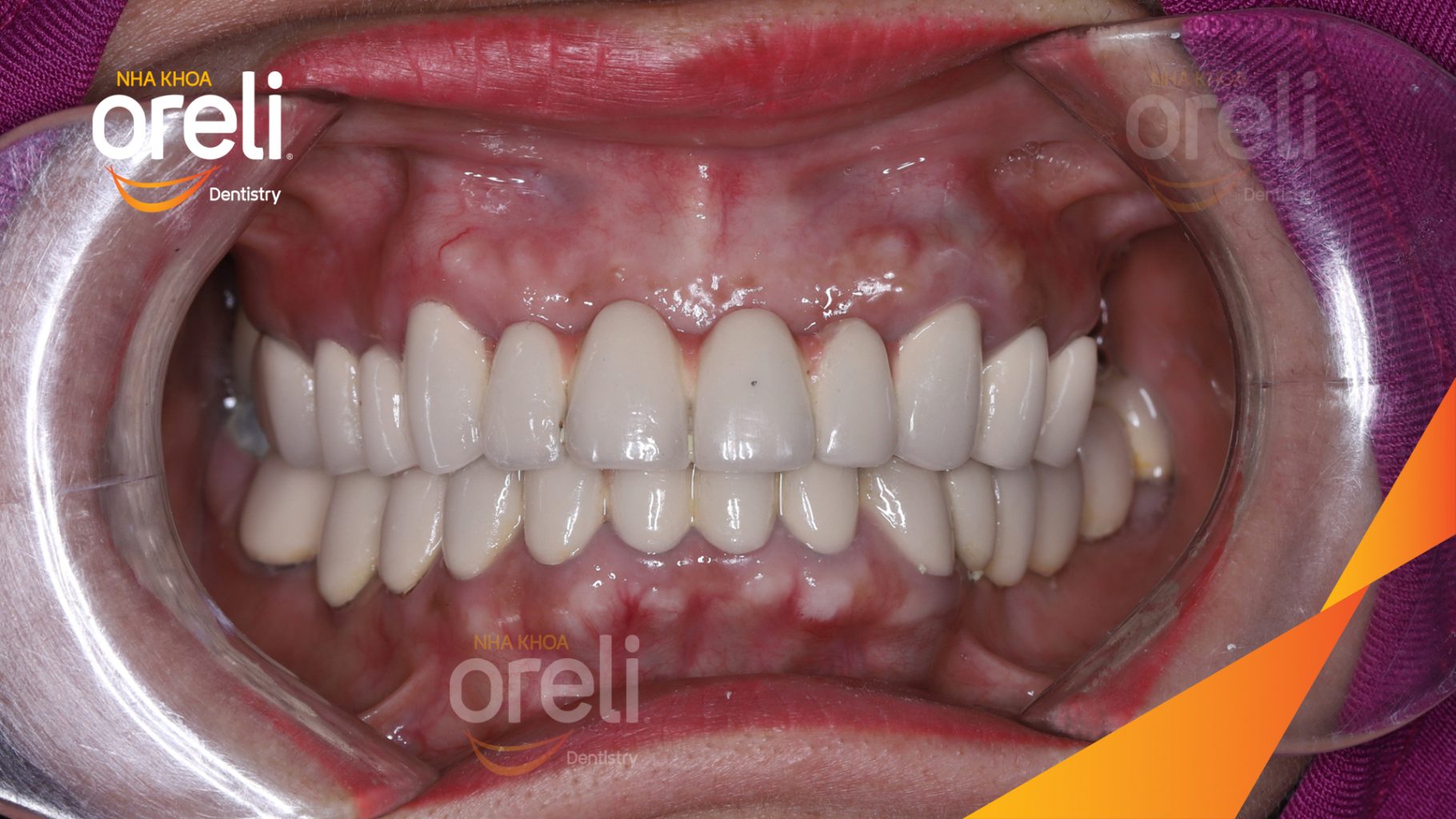 Quá trình Cắt bỏ cầu răng nhổ các chân răng trồng implant all on six trong 1 tuần tại Nha khoa Oreli