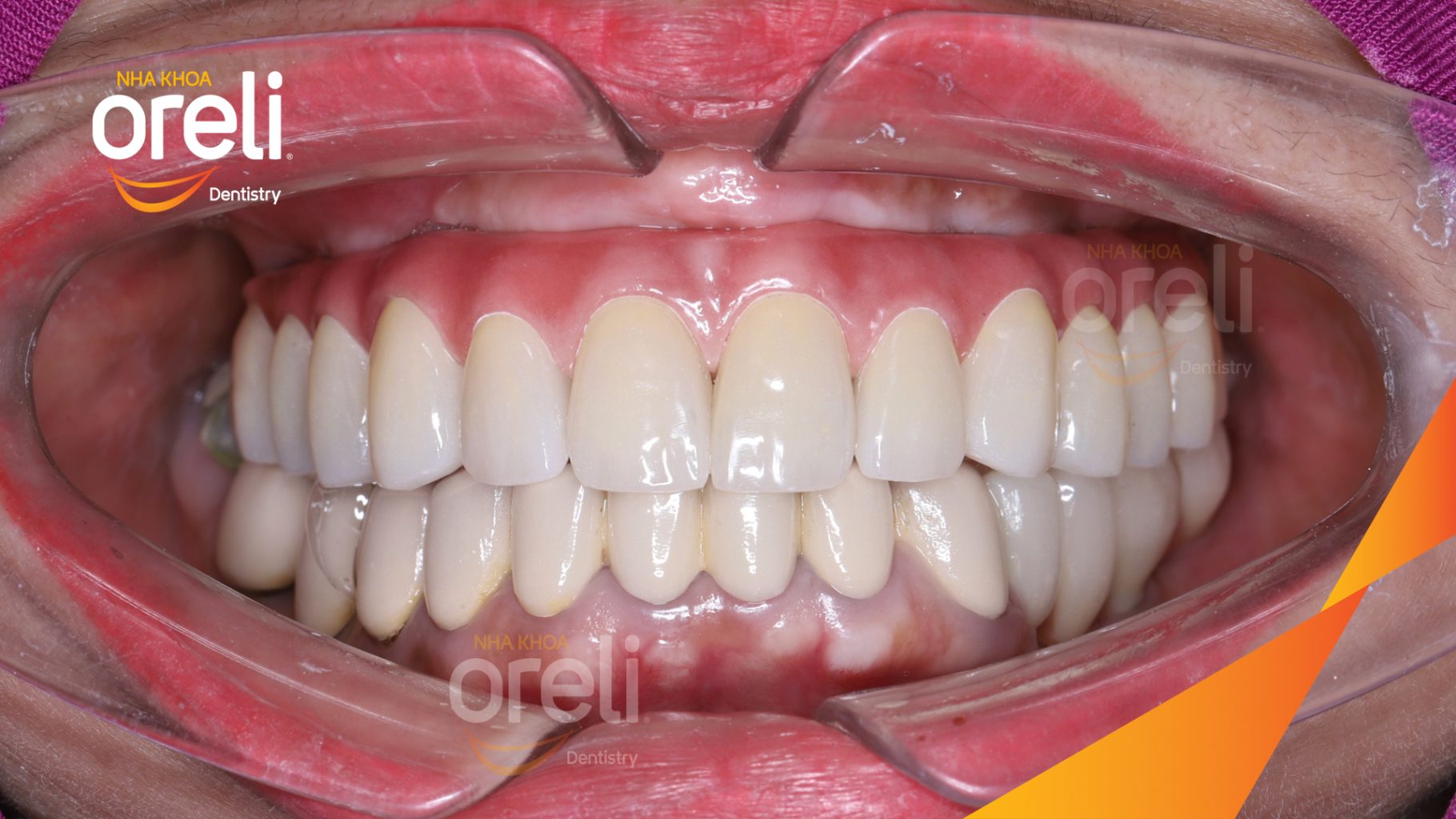 Thực hiện Cắt bỏ cầu răng nhổ các chân răng trồng implant all on six kéo dài 1 tuần tại Nha khoa Oreli