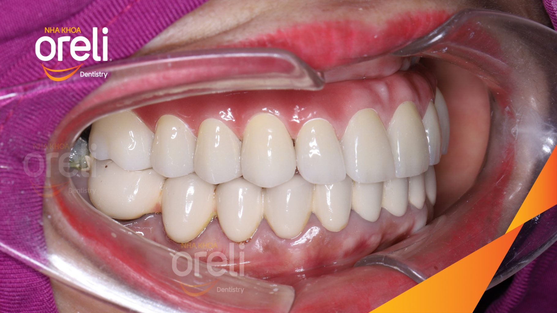 Trước điều trị: Cầu răng sứ hàm trên lung lay, các chân răng cũ tiêu xương tại Nha khoa Oreli