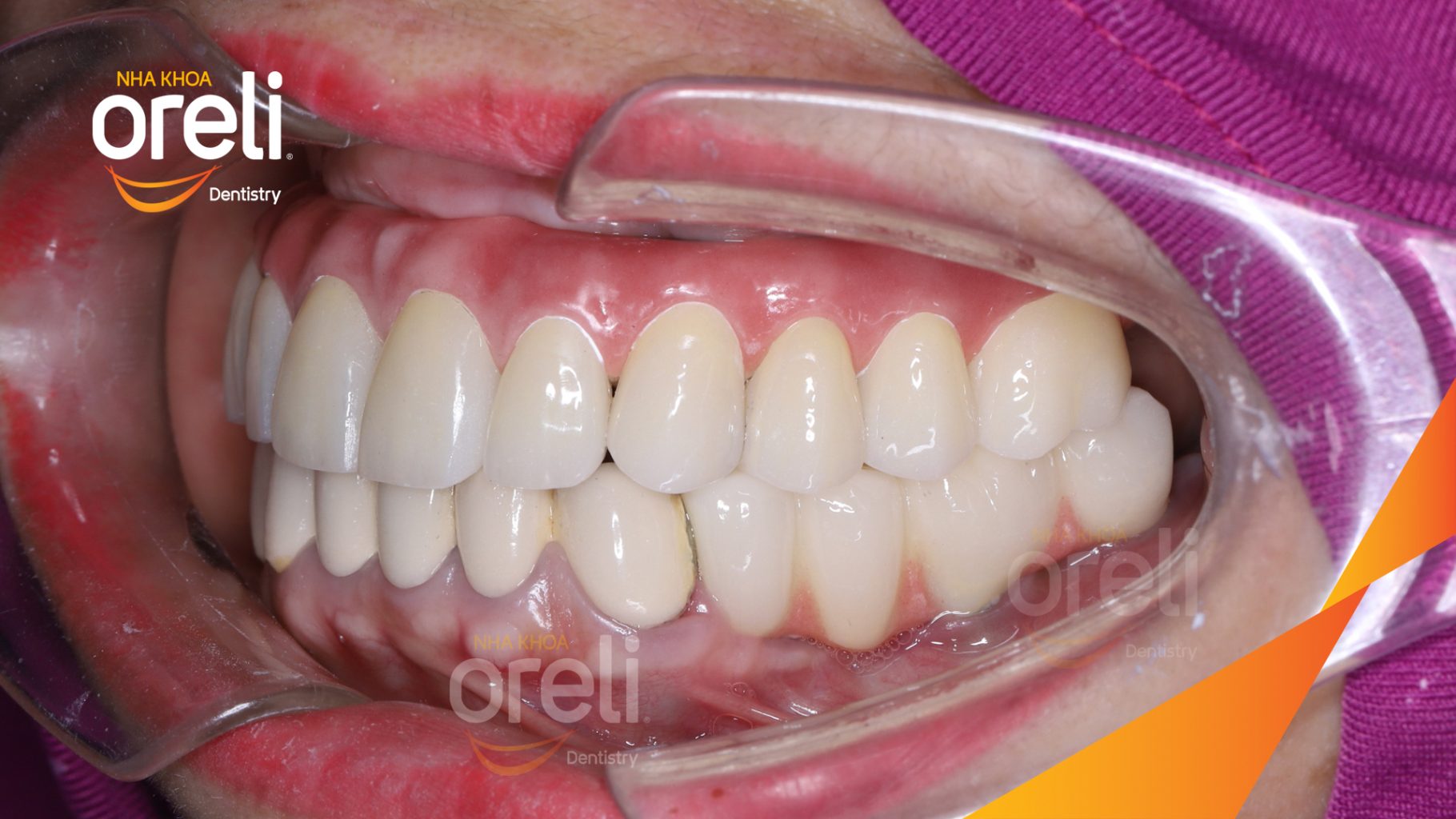 Cầu răng sứ hàm trên lung lay, các chân răng cũ tiêu xương trước khi điều trị tại Nha khoa Oreli