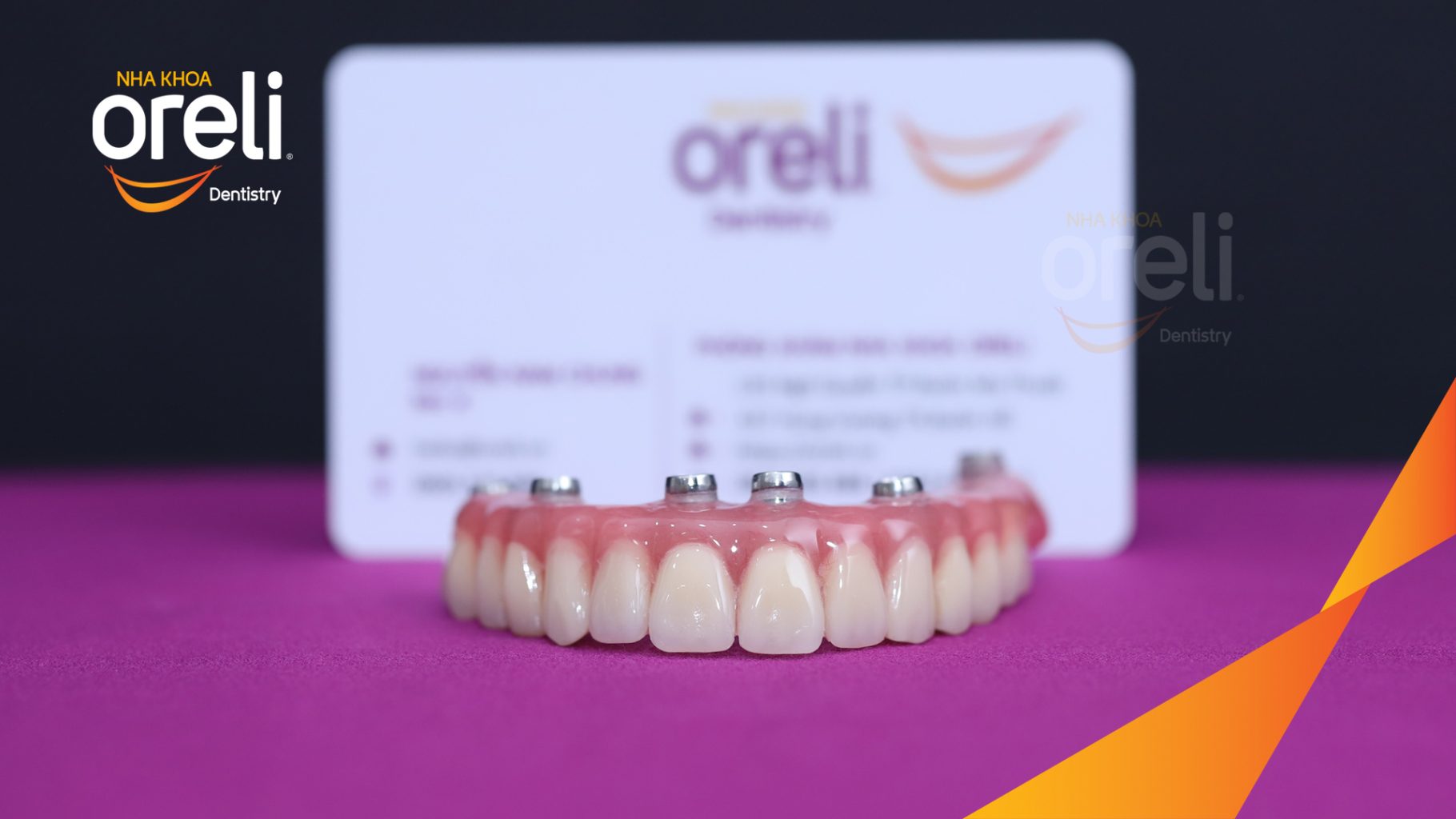 Kết quả sau 1 tuần: Thẩm mỹ tự nhiên ăn nhai chắc chắn tại Nha khoa Oreli