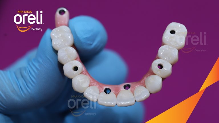 Ca trồng răng implant hàm trên và ba răng hàm dưới hình ảnh trước sau