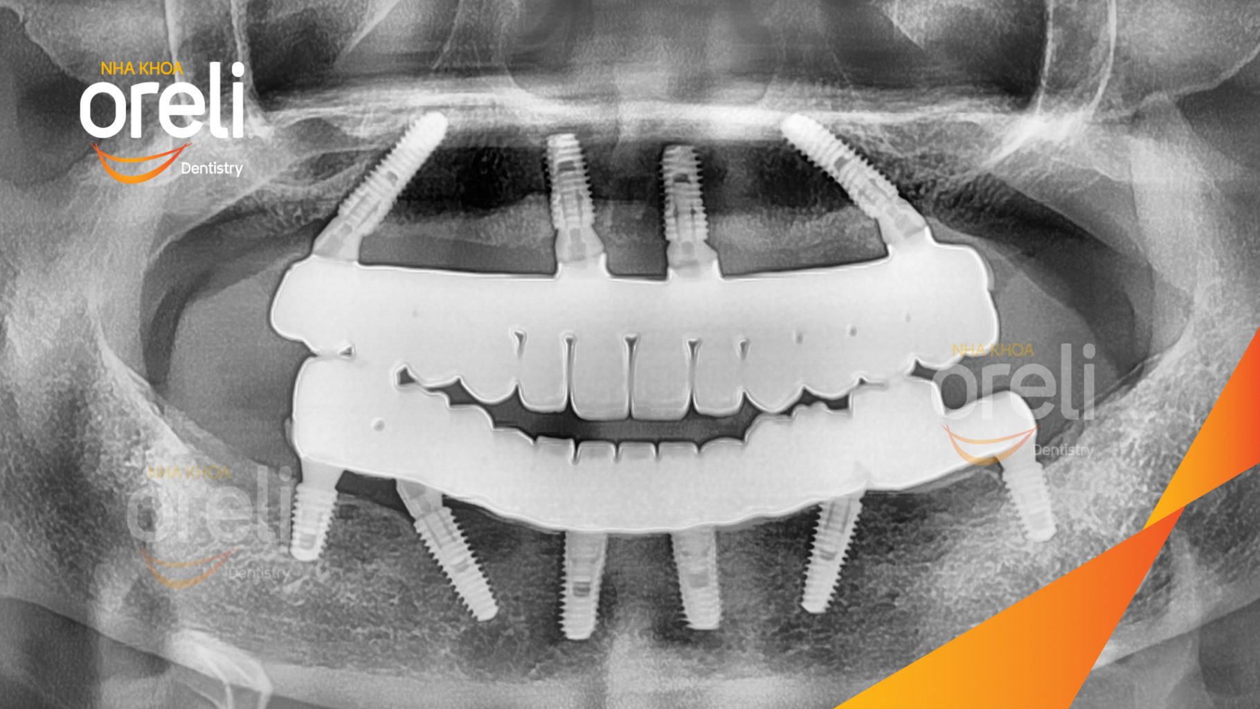 Mất răng lâu ngày cả trên và dưới đặc biệt vùng răng sau trước khi điều trị tại Nha khoa Oreli