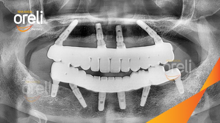 Ca trồng răng implant hai hàm cho mất răng toàn bộ | Nha khoa Oreli