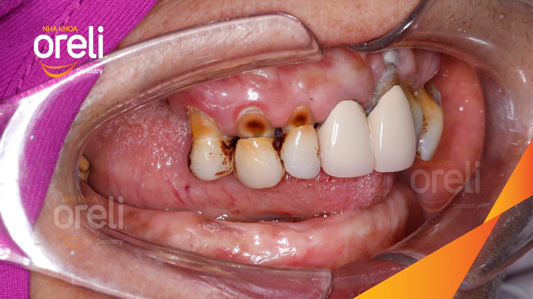 Trước điều trị: Mất răng lâu ngày cả trên và dưới đặc biệt vùng răng sau tại Nha khoa Oreli