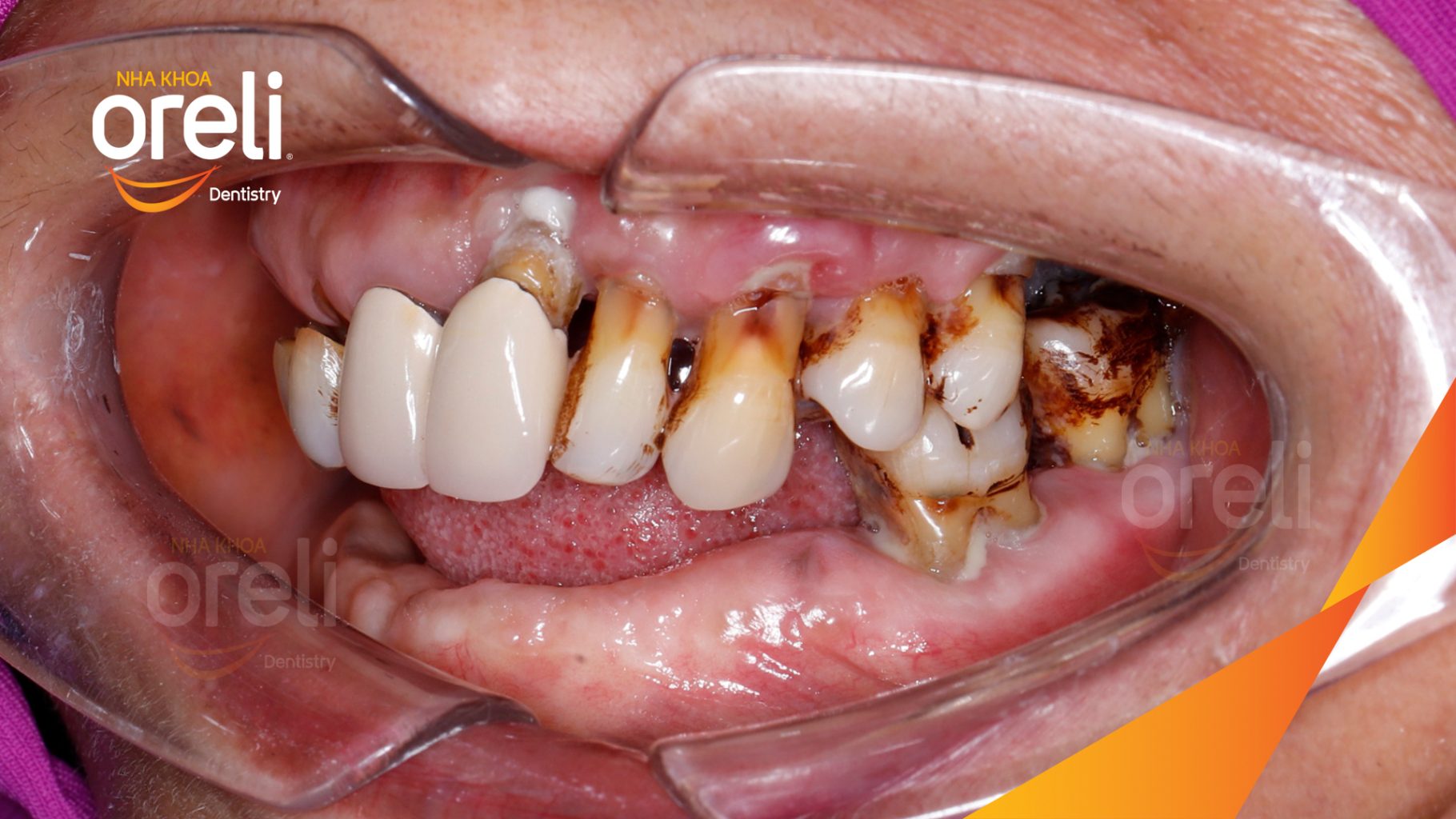 Mất răng lâu ngày cả trên và dưới đặc biệt vùng răng sau trước khi điều trị tại Nha khoa Oreli