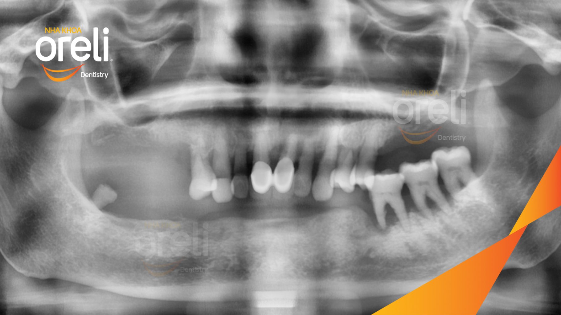 Trước điều trị: Mất răng lâu ngày cả trên và dưới đặc biệt vùng răng sau tại Nha khoa Oreli