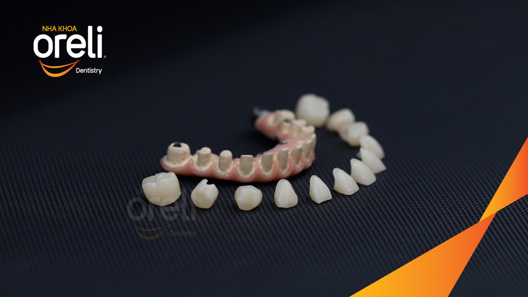 Kết quả sau 2 tuần: Phục hồi ăn nhai chắc chắn và cười nói tự tin tại Nha khoa Oreli