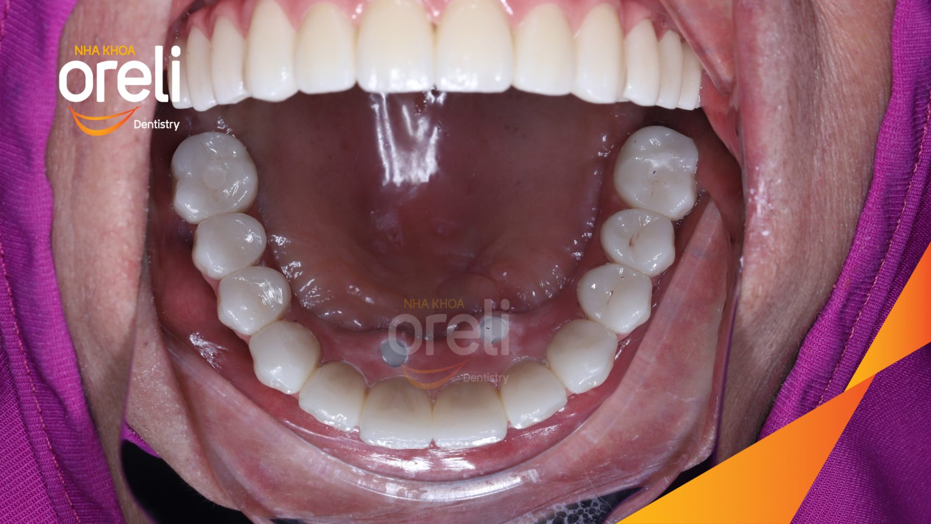 Kết quả đạt được sau 2 tuần - Phục hồi ăn nhai chắc chắn và cười nói tự tin tại Nha khoa Oreli