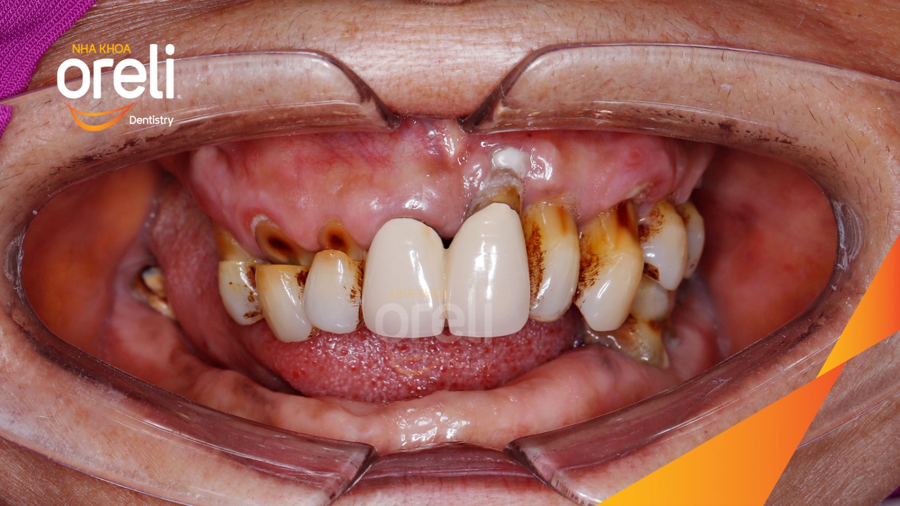 Quá trình Nhổ răng toàn bộ các răng còn lại do lung lay mất khả năng hồi phục trong 2 tuần tại Nha khoa Oreli