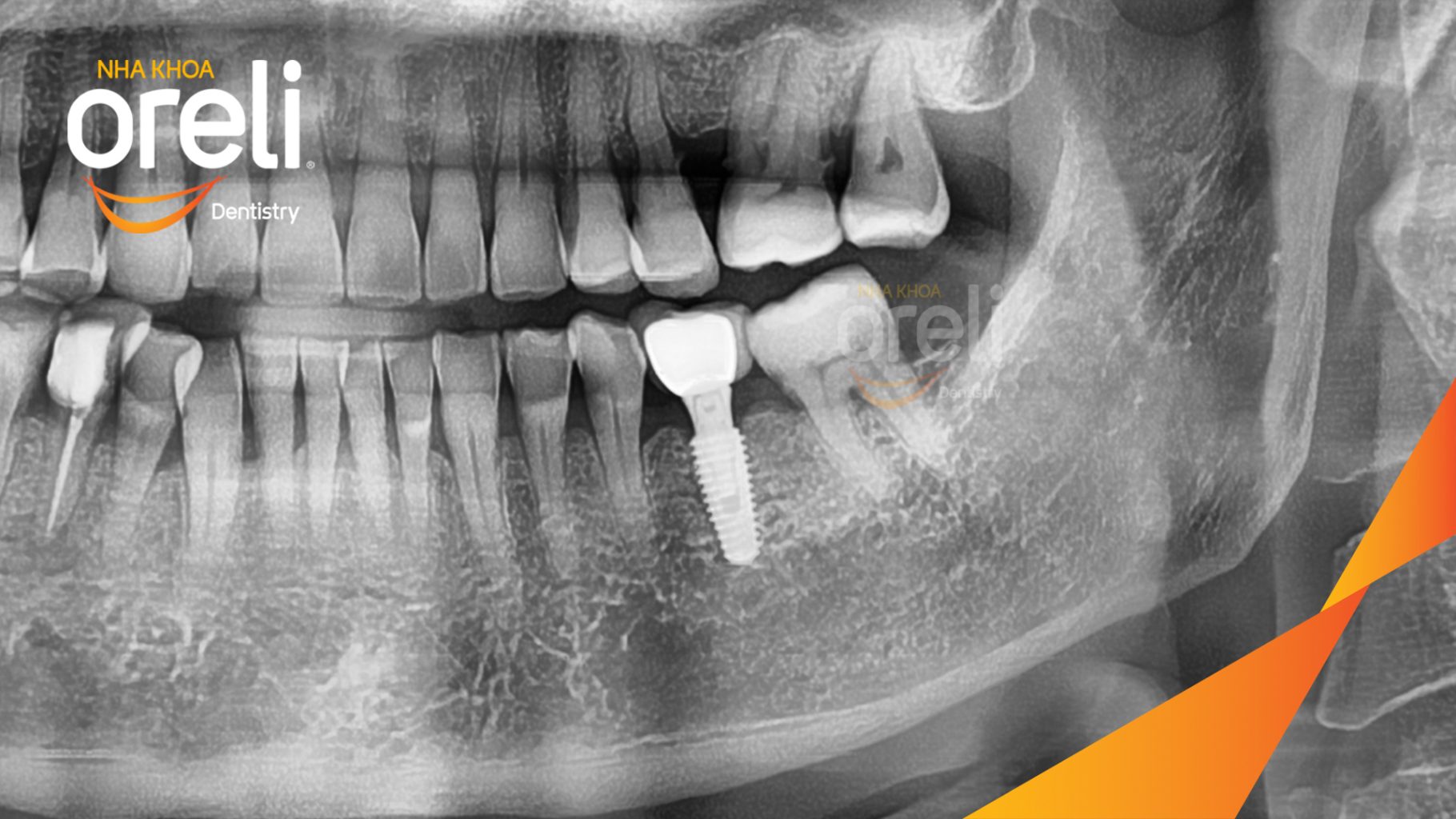 Quá trình Cấy ghép trụ Implant chính  hãng vào vùng  mất  răng trong 3 tháng tại Oreli