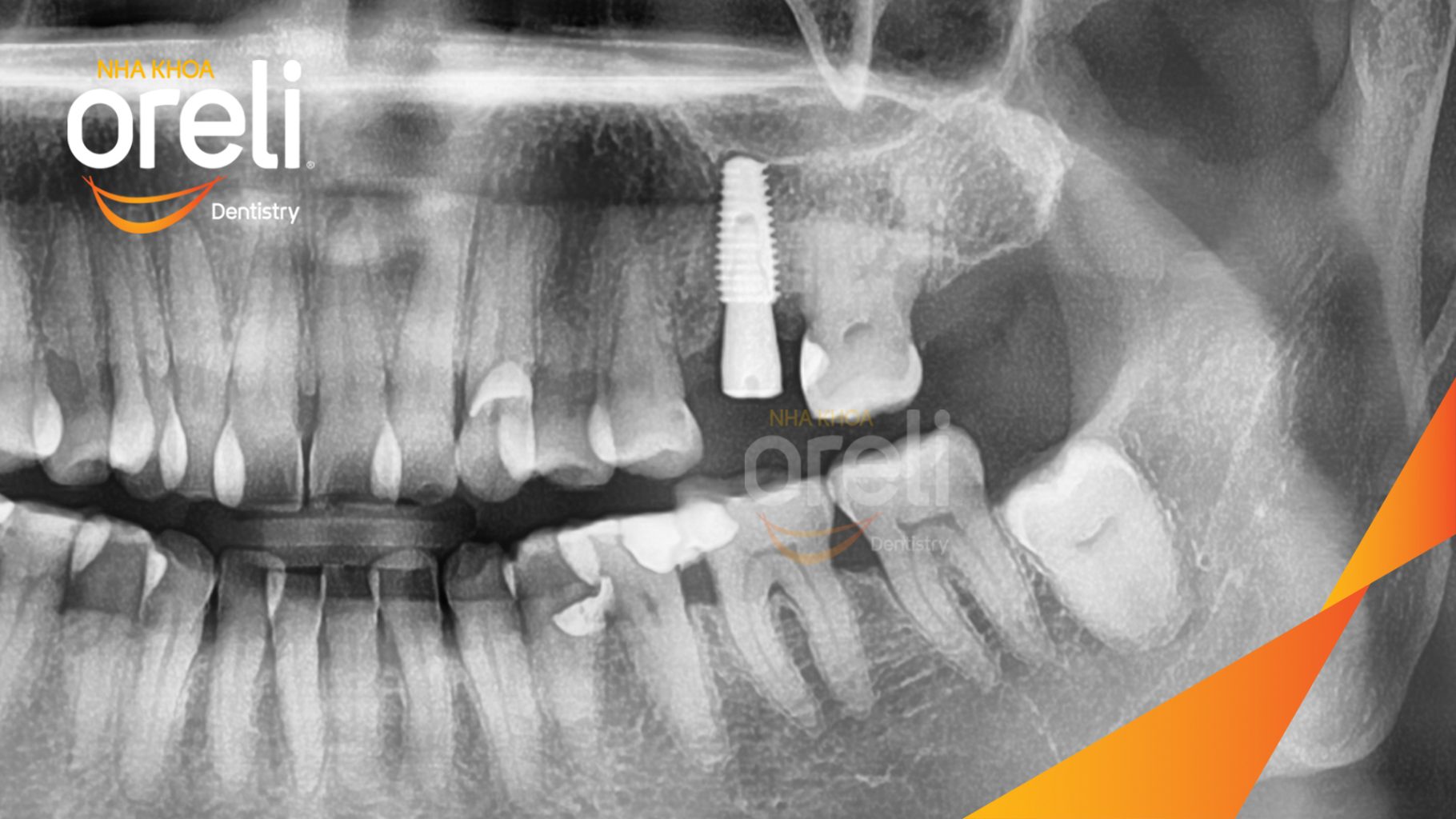 Mất răng hàm ảnh hưởng chức năng ăn nhai trước khi điều trị tại Oreli