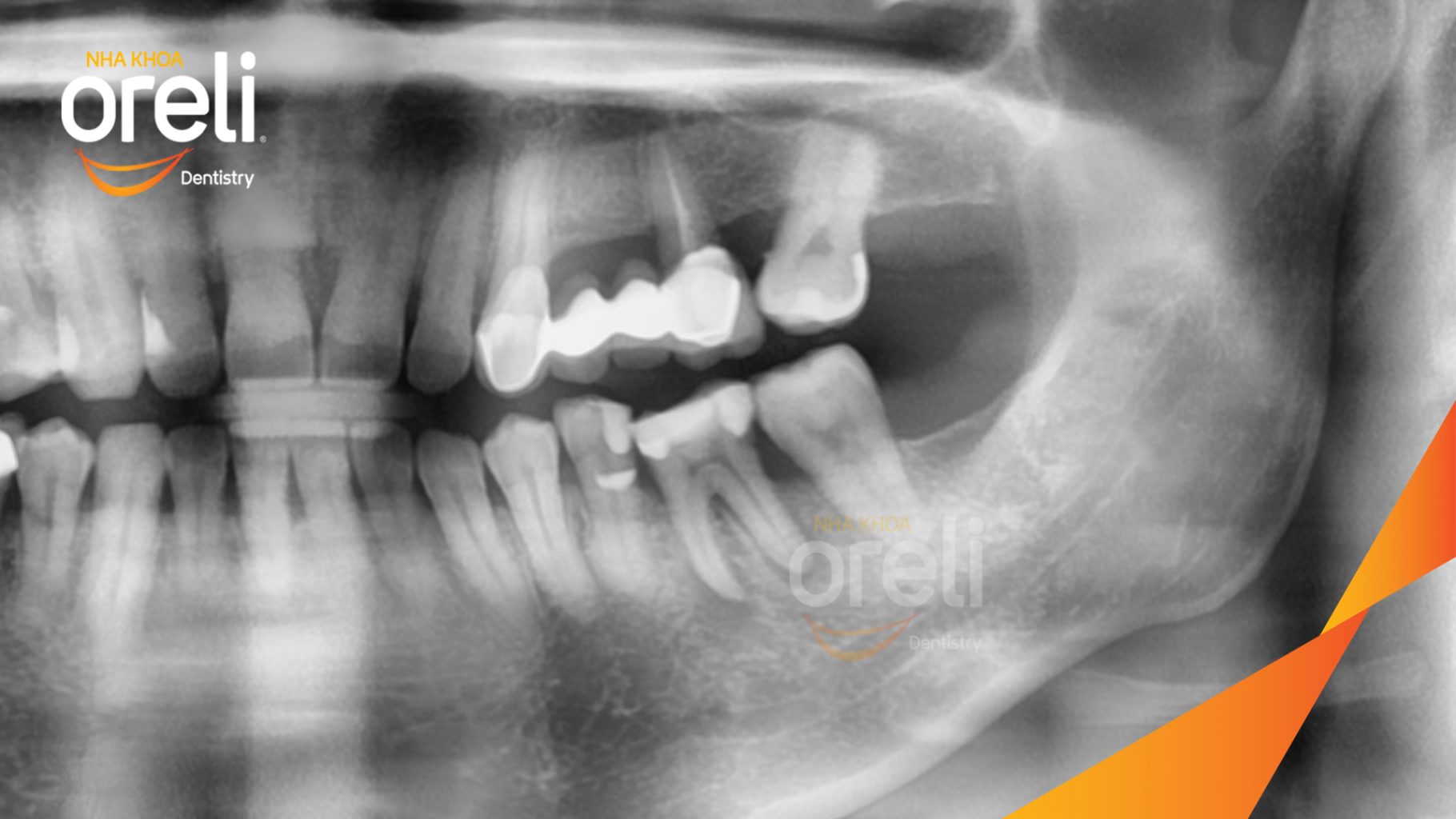Răng khôn hàm dưới sâu lớn, mô răng vỡ nhiều . Thức ăn dễ mắc vào lỗ sâu gây đau nhức, ê buốt trước khi điều trị tại Oreli