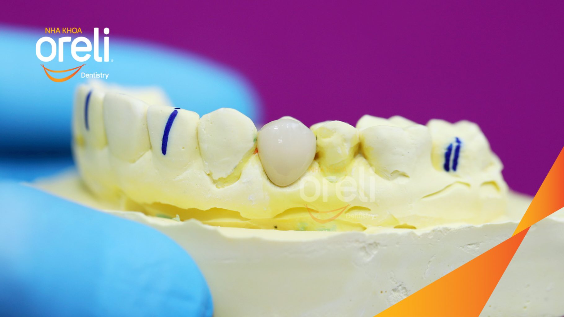 Quá trình Dán sứ Veneer thẩm mỹ với thiết kế dáng răng tự nhiên trong 2 – 3 buổi tại Oreli