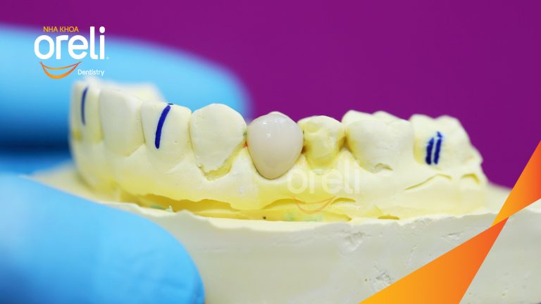 Dán sứ Veneer tại Buôn Ma Thuột | Nha khoa Oreli