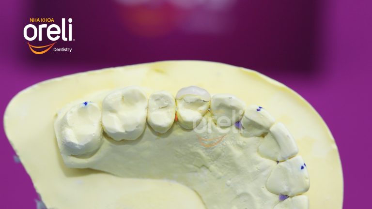 Dán sứ Veneer tại Buôn Ma Thuột | Nha khoa Oreli