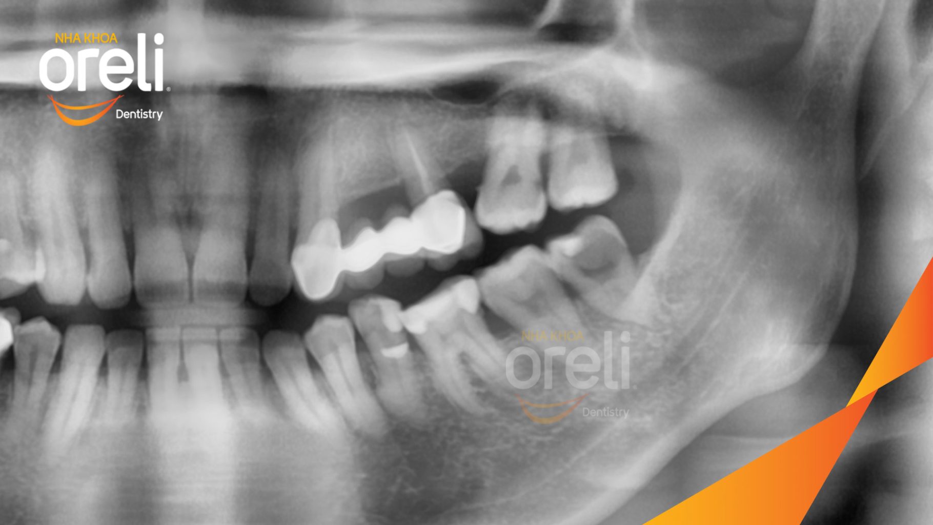 Trước điều trị: Răng khôn hàm dưới sâu lớn, mô răng vỡ nhiều . Thức ăn dễ mắc vào lỗ sâu gây đau nhức, ê buốt tại Oreli
