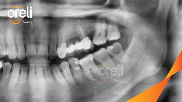 Ca Nhổ Răng Khôn Hàm Trên – Dưới Sâu Lớn l Case Thực Tế Tại Oreli Buôn Ma Thuột