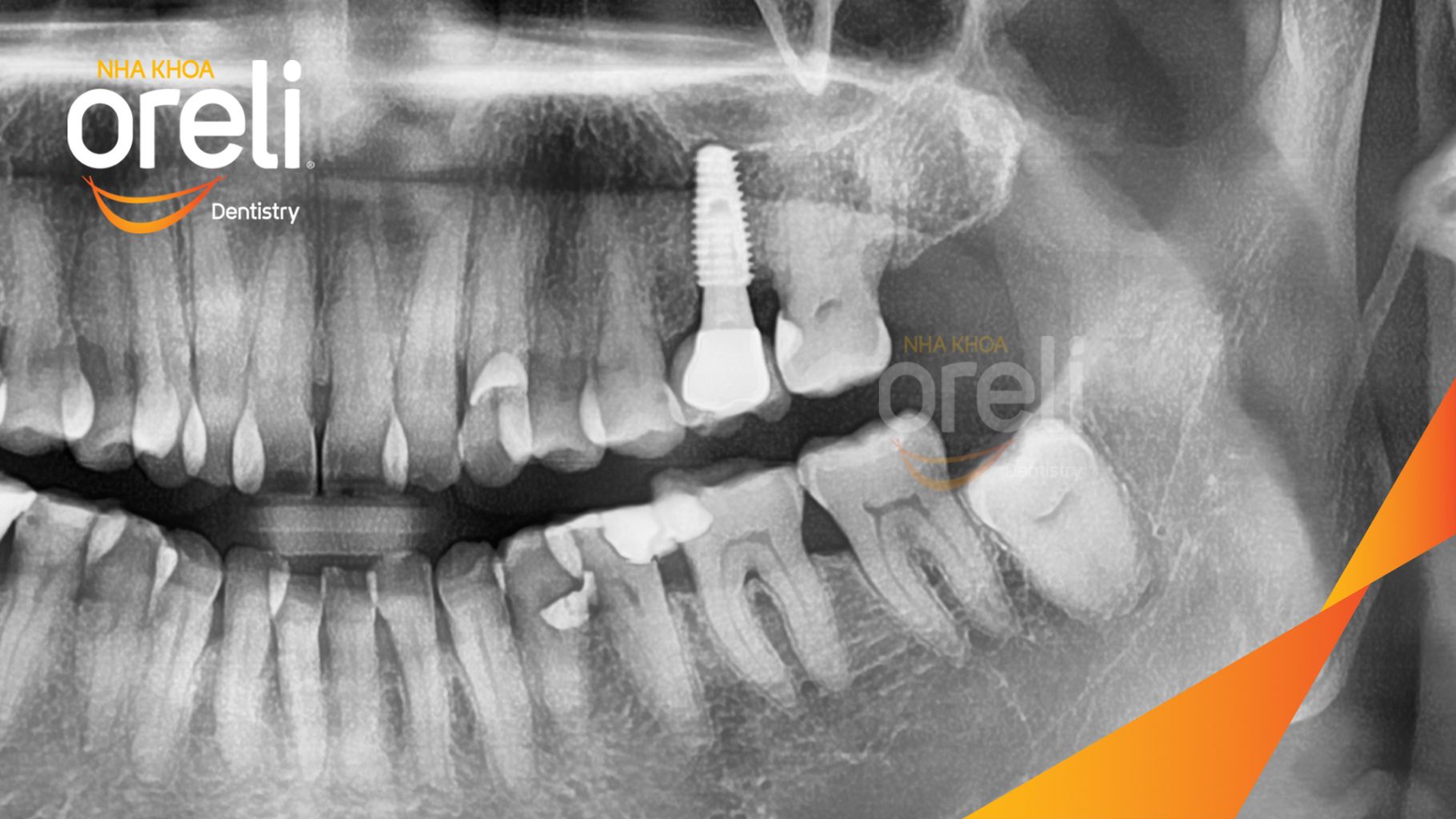 Quá trình Tiến hành cấy ghép trụ Implant đúng vị trí mất răng, phục hình sứ trên Implant giúp khôi phục chức năng và thẩm mỹ trong 3 tháng tại Oreli