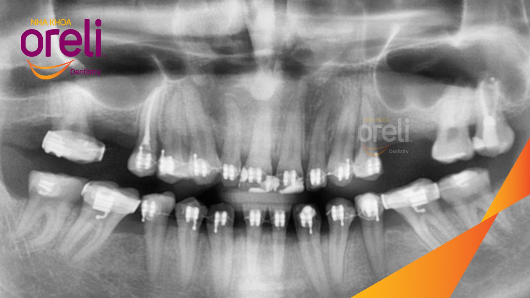 Trước điều trị: Mất răng hàm trên, xương hàm tiêu nhiều, chiều cao xương không đủ để đặt Implant tại Oreli