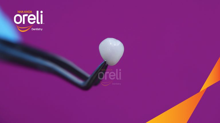 Dán sứ Veneer tại Buôn Ma Thuột | Nha khoa Oreli