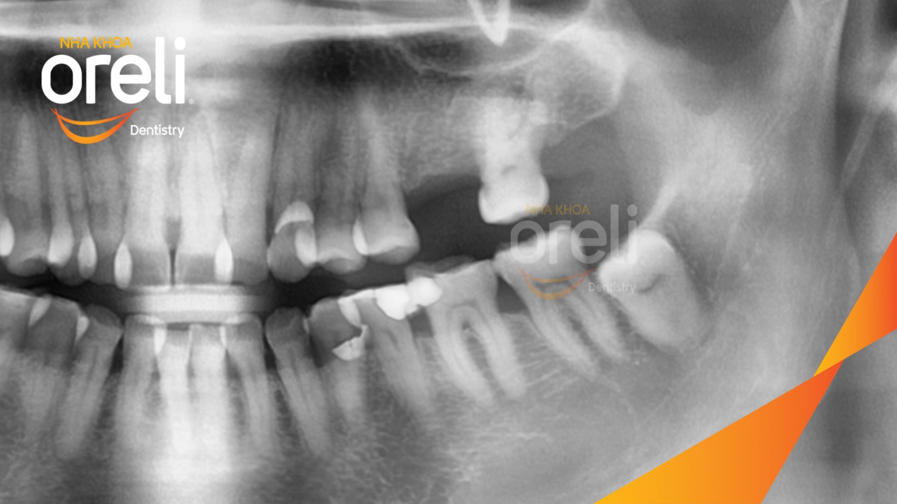 Trước điều trị: Mất răng hàm ảnh hưởng chức năng ăn nhai tại Oreli