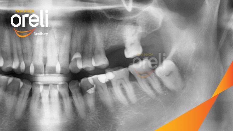 Ca Cấy Ghép Implant Phục Hồi Răng Tại Nha Khoa Oreli