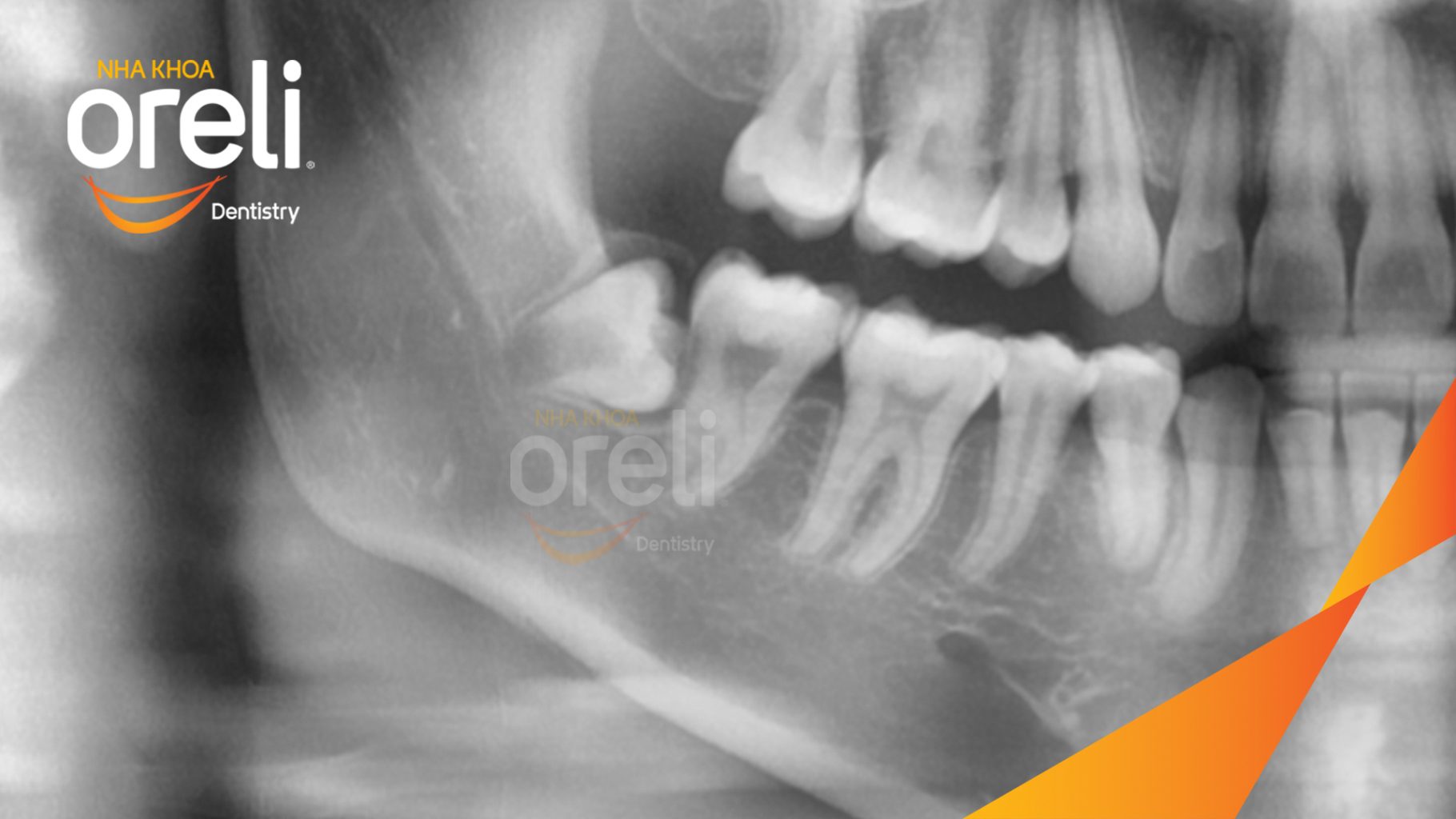 Trước điều trị: Răng khôn hàm dưới mọc lệch, chèn ép răng số 7 gây đau nhức âm ỉ tại Oreli