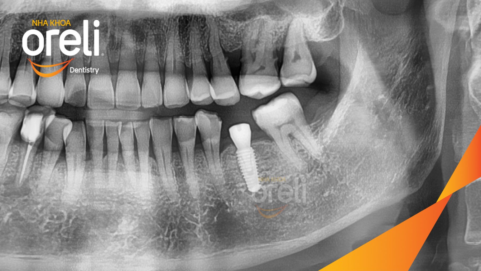 Mất răng hàm dưới trước khi điều trị tại Oreli