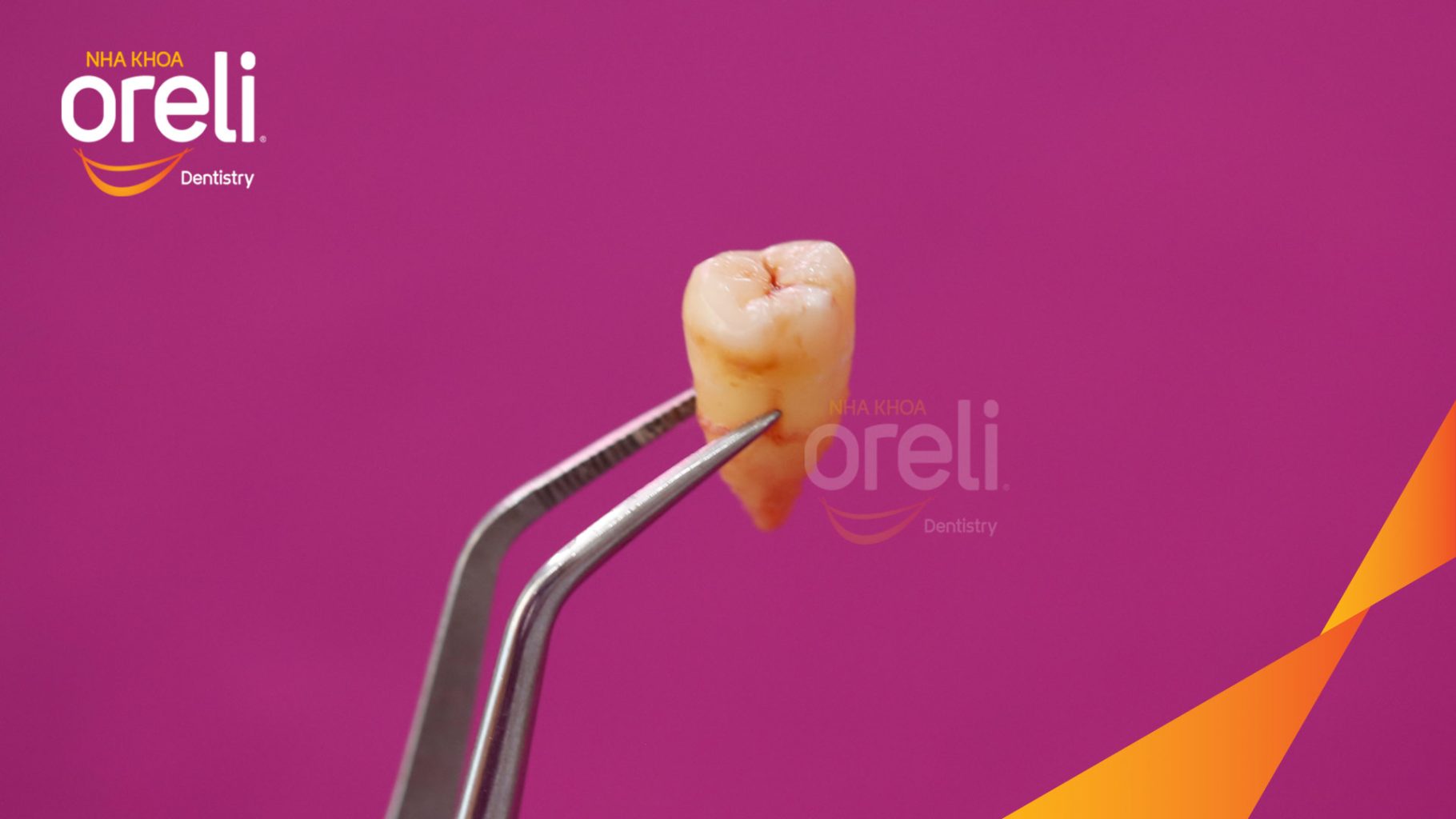 Kết quả đạt được sau 45 phút - Loại bỏ răng khôn, ổ sâu viêm nhiễm tại Oreli
