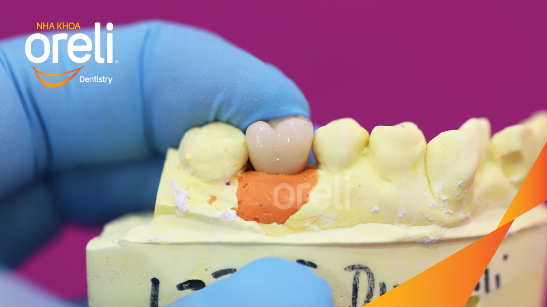 Kết quả sau 3 tháng: Phục hồi răng mất - ăn nhai chắc chắn và cười nói tự tin tại Oreli