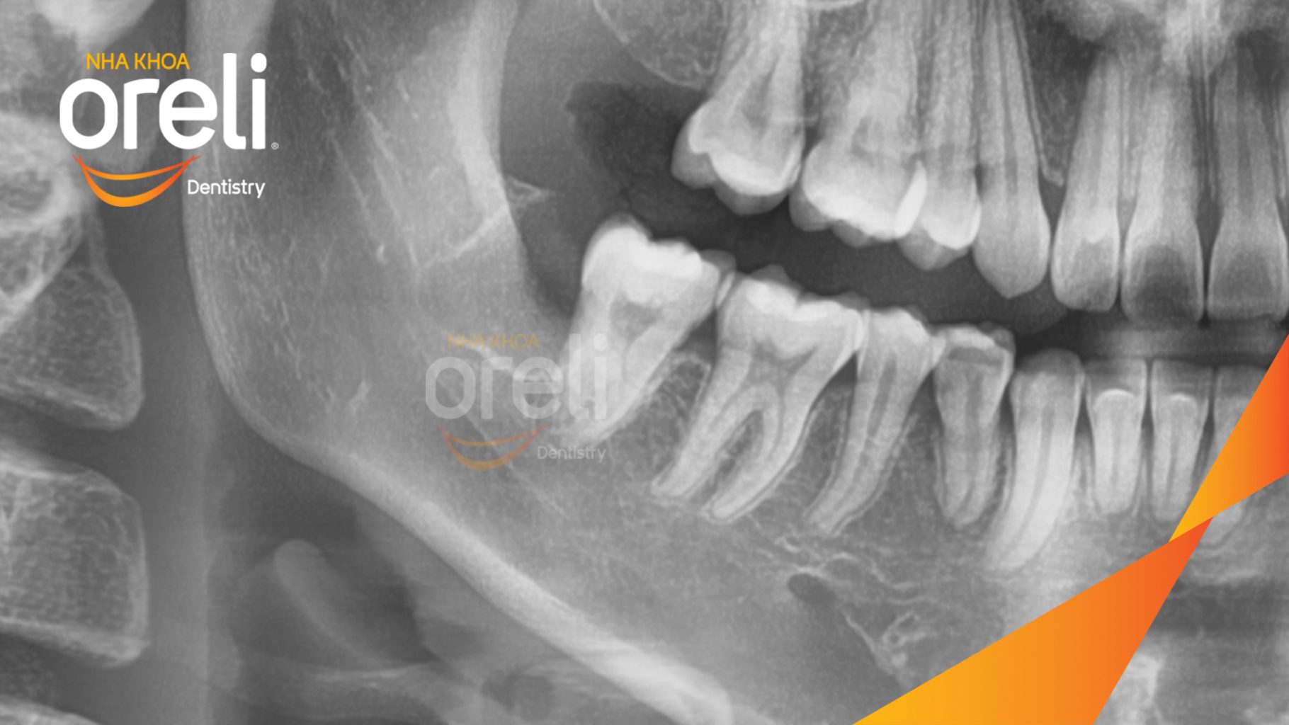Răng khôn hàm dưới mọc lệch, chèn ép răng số 7 gây đau nhức âm ỉ trước khi điều trị tại Oreli