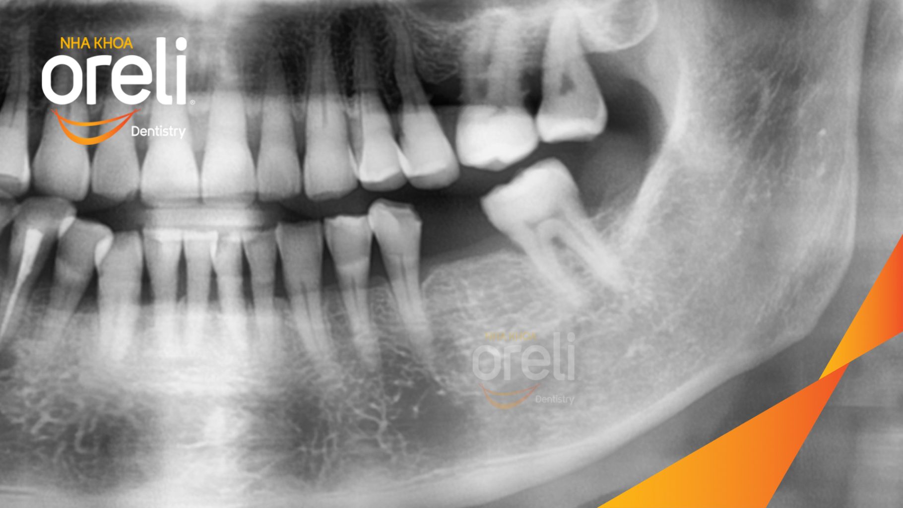 Trước điều trị: Mất răng hàm dưới tại Oreli