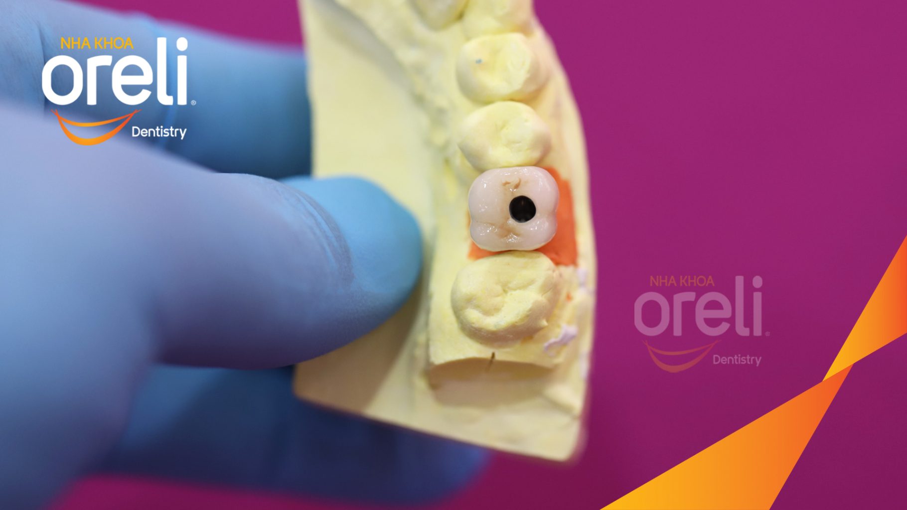 Thực hiện Tiến hành cấy ghép trụ Implant đúng vị trí mất răng, phục hình sứ trên Implant giúp khôi phục chức năng và thẩm mỹ kéo dài 3 tháng tại Oreli