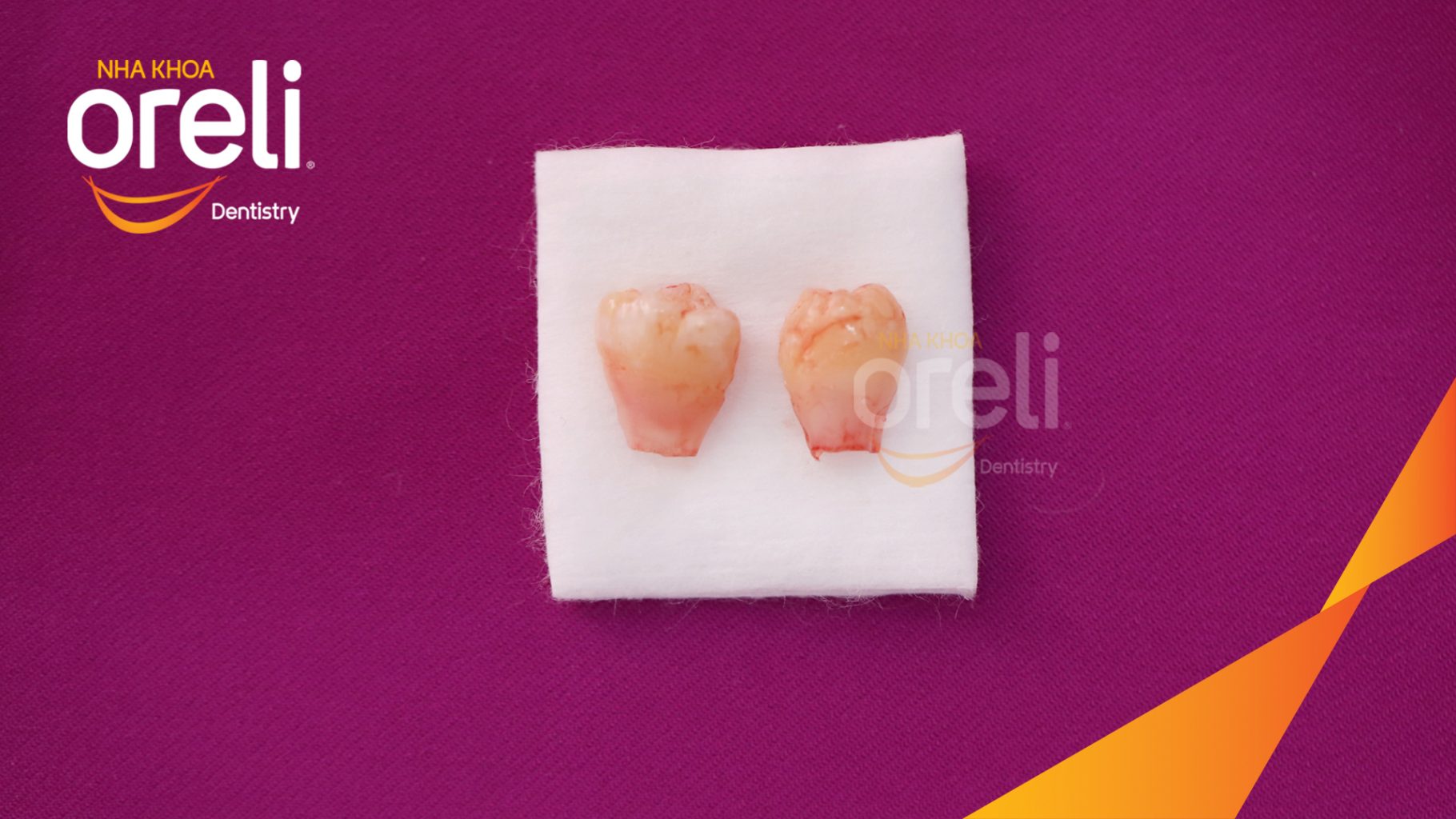 Quá trình Nhổ răng khôn hàm dưới bên trái trong 30 phút tại Oreli